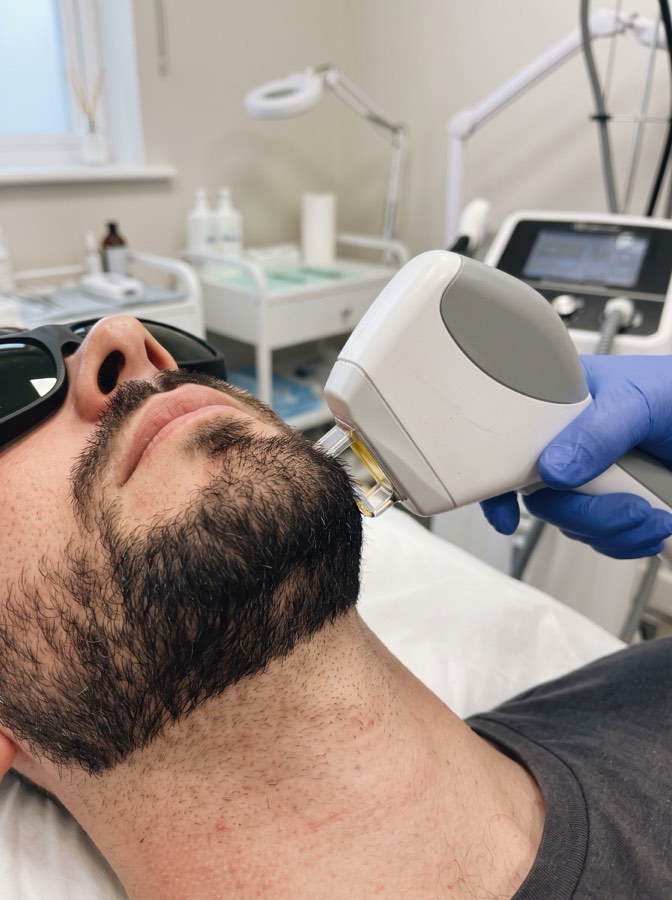 IPL Facial completo con marcación de barba (hombre)